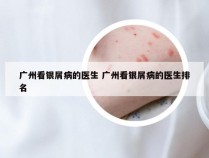 广州看银屑病的医生 广州看银屑病的医生排名