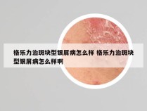 格乐力治斑块型银屑病怎么样 格乐力治斑块型银屑病怎么样啊