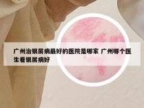 广州治银屑病最好的医院是哪家 广州哪个医生看银屑病好