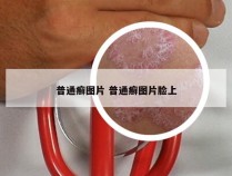 普通癣图片 普通癣图片脸上