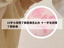 10岁小孩得了银屑病怎么办 十一岁女孩得了银屑病