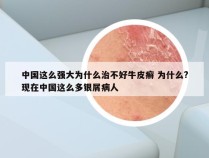 中国这么强大为什么治不好牛皮癣 为什么?现在中国这么多银屑病人
