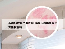 小孩10岁得了牛皮癣 10岁小孩牛皮癣长大能自愈吗