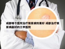 成都哪个医院治疗银屑病效果好 成都治疗银屑病最好的三甲医院