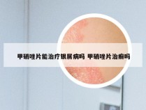 甲硝唑片能治疗银屑病吗 甲硝唑片治癣吗