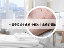 中医专家谈牛皮癣 中医对牛皮癣的看法