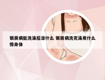 银屑病能洗澡后涂什么 银屑病洗完澡用什么擦身体