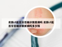 皮肤ct能百分百确诊银屑病吗 皮肤ct能百分百确诊银屑病吗多少钱