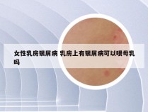 女性乳房银屑病 乳房上有银屑病可以喂母乳吗