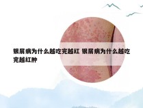银屑病为什么越吃完越红 银屑病为什么越吃完越红肿
