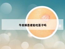 牛皮癣患者能吃莲子吗