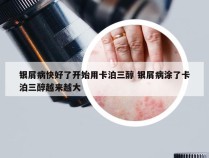银屑病快好了开始用卡泊三醇 银屑病涂了卡泊三醇越来越大