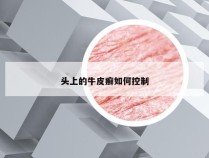 头上的牛皮癣如何控制