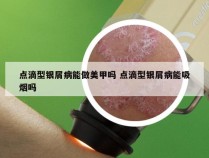 点滴型银屑病能做美甲吗 点滴型银屑病能吸烟吗