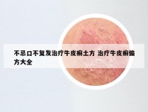 不忌口不复发治疗牛皮癣土方 治疗牛皮癣偏方大全