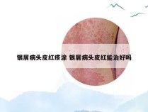 银屑病头皮红疹涂 银屑病头皮红能治好吗