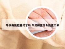 牛皮癣能检查出了吗 牛皮癣查什么能查出来