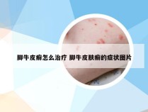 脚牛皮癣怎么治疗 脚牛皮肤癣的症状图片
