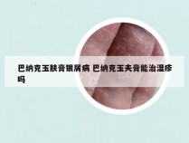 巴纳克玉肤膏银屑病 巴纳克玉夫膏能治湿疹吗
