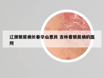辽源银屑病长春华山惠民 吉林看银屑病的医院