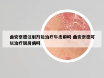 曲安奈德注射剂能治疗牛皮癣吗 曲安奈德可以治疗银屑病吗