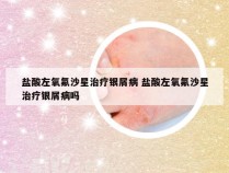 盐酸左氧氟沙星治疗银屑病 盐酸左氧氟沙星治疗银屑病吗