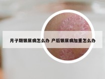 月子期银屑病怎么办 产后银屑病加重怎么办