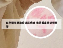 在承德哪里治疗银屑病好 承德看皮肤病哪里好