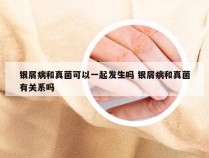 银屑病和真菌可以一起发生吗 银屑病和真菌有关系吗