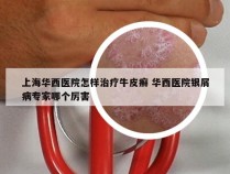 上海华西医院怎样治疗牛皮癣 华西医院银屑病专家哪个厉害
