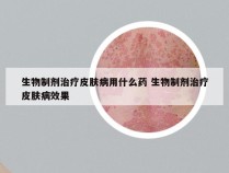 生物制剂治疗皮肤病用什么药 生物制剂治疗皮肤病效果