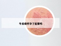 牛皮癣怀孕了能要吗