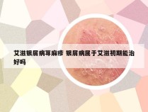 艾滋银屑病荨麻疹 银屑病属于艾滋初期能治好吗