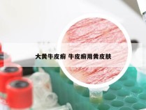 大黄牛皮癣 牛皮癣用黄皮肤