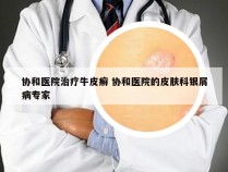 协和医院治疗牛皮癣 协和医院的皮肤科银屑病专家