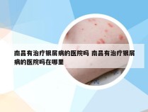 南昌有治疗银屑病的医院吗 南昌有治疗银屑病的医院吗在哪里