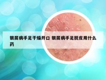 银屑病手足干燥开口 银屑病手足脱皮用什么药
