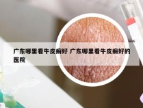 广东哪里看牛皮癣好 广东哪里看牛皮癣好的医院