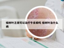 榆树叶之液可以治疗牛皮癣吗 榆树叶治什么病