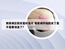 银屑病总脱皮是好是坏 银屑病开始脱皮了是不是要消退了?