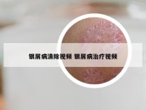 银屑病清除视频 银屑病治疗视频