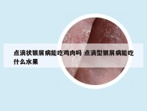点滴状银屑病能吃鸡肉吗 点滴型银屑病能吃什么水果