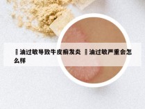 焗油过敏导致牛皮癣发炎 焗油过敏严重会怎么样