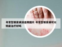 寻常型银屑病消退期图片 寻常型银屑病可以彻底治疗好吗