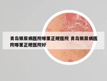 青岛银屑病医院哪里正规医院 青岛银屑病医院哪里正规医院好