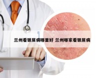 兰州看银屑病哪里好 兰州哪家看银屑病