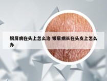 银屑病在头上怎么治 银屑病长在头皮上怎么办