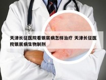 天津长征医院看银屑病怎样治疗 天津长征医院银屑病生物制剂