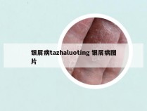 银屑病tazhaluoting 银屑病图片