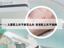 儿童脸上长干癣怎么办 宝宝脸上长干燥癣